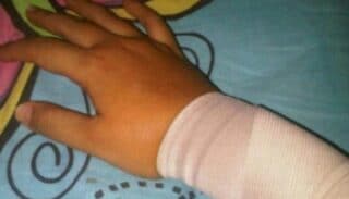 Alami Kecelakaan Kerja Seorang Karyawan PT SWPI Kehilangan Tangannya